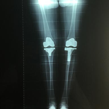 Chirurgia al ginocchio